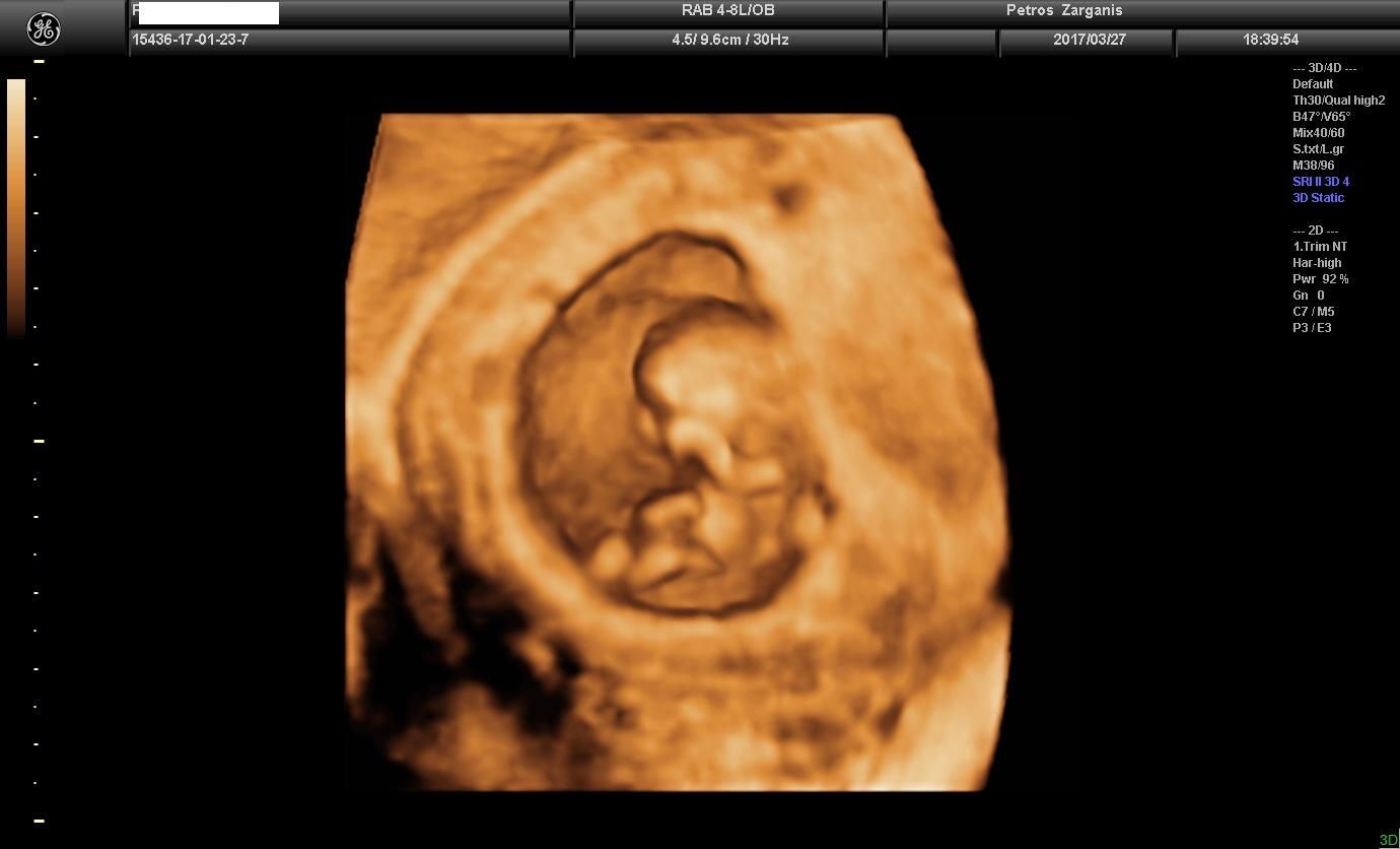 Εμβρυο 10+4 εβδομάδων τρισδιάστατη υπερηχογραφία2