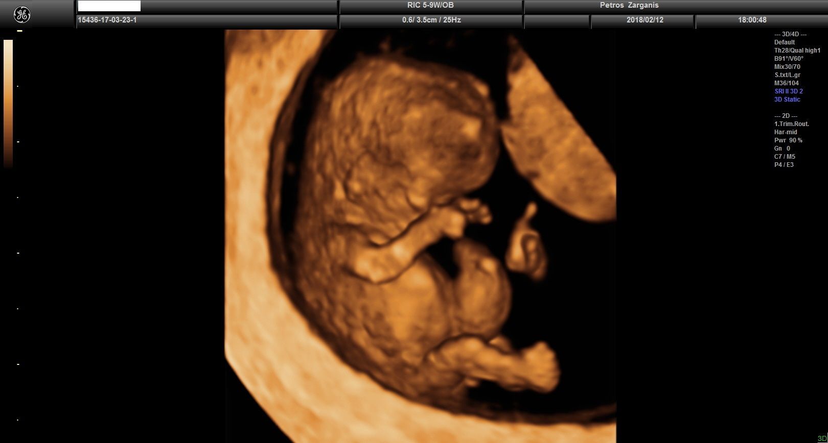 Εμβρυο 10+5 εβδομάδων τρισδιάστατη υπερηχογραφία