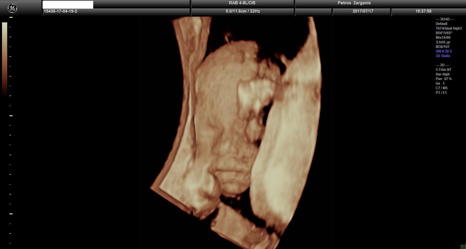 Εμβρυο 24  εβδομάδων [1] Τρισδιάστατη Υπερηχογραφία