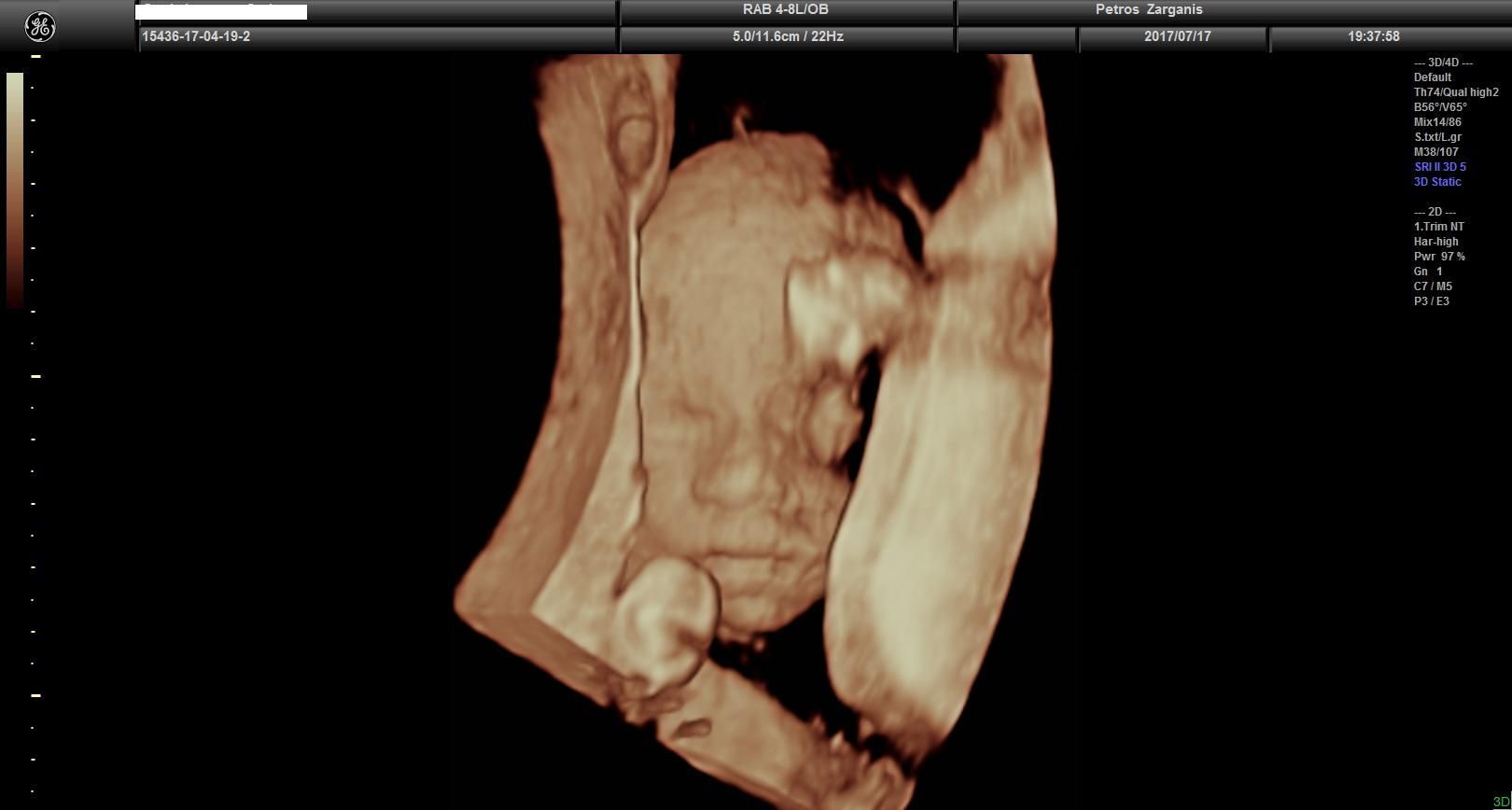 Εμβρυο 24  εβδομάδων [2] Τρισδιάστατη Υπερηχογραφία