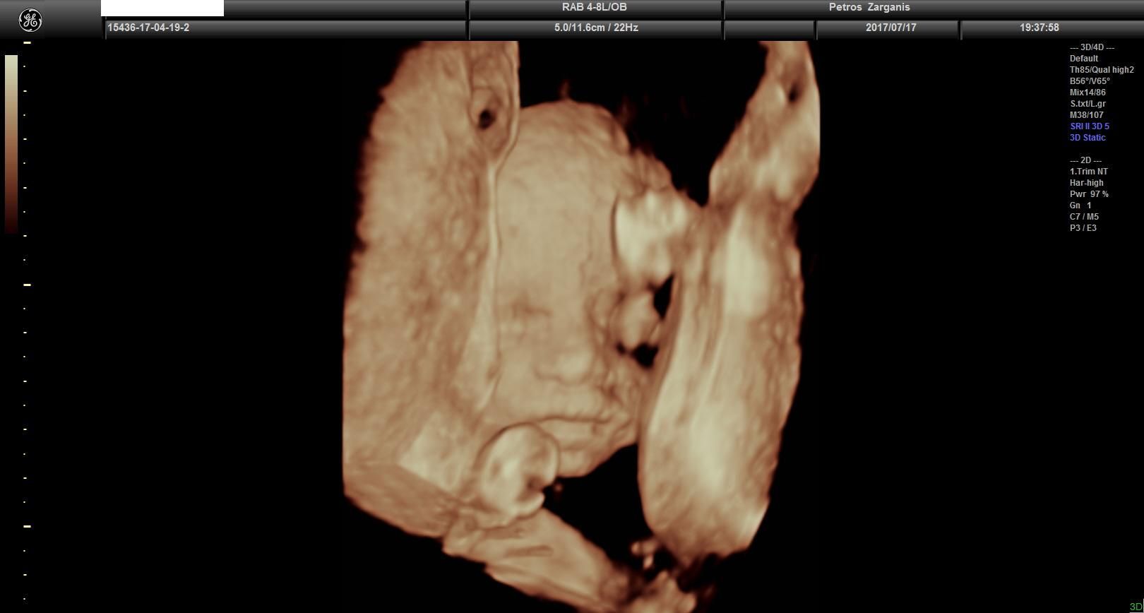 Εμβρυο 24  εβδομάδων [4] Τρισδιάστατη Υπερηχογραφία