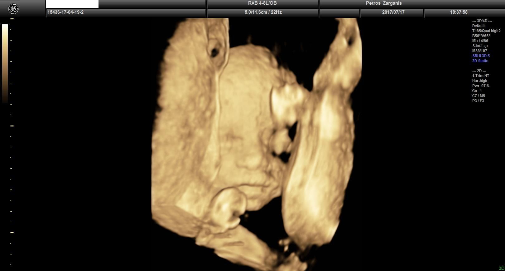 Εμβρυο 24  εβδομάδων [5]Τρισδιάστατη Υπερηχογραφία