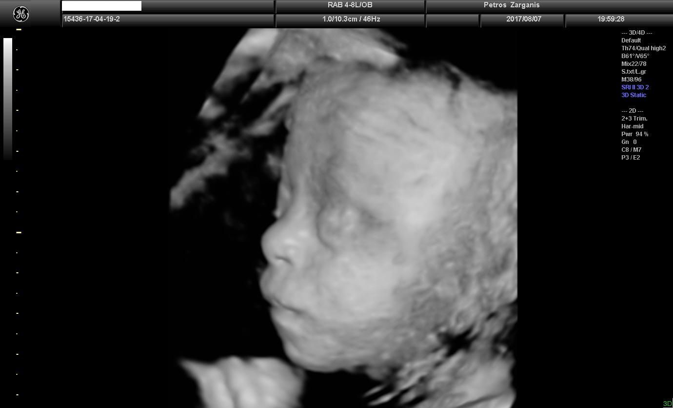 Εμβρυο 26+3  εβδομάδων [1] Τρισδιάστατη Υπερηχογραφία