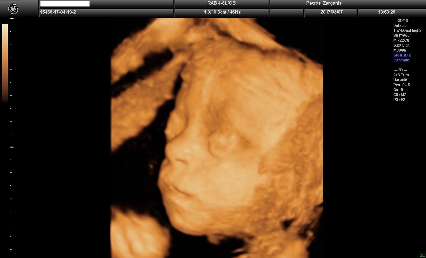 Εμβρυο 26+3  εβδομάδων [3] Τρισδιάστατη Υπερηχογραφία