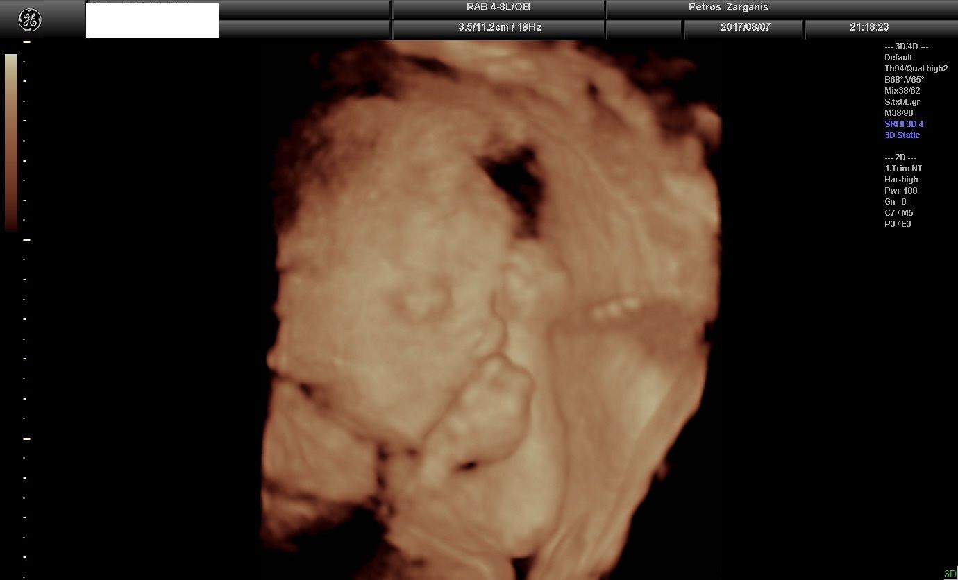 Εμβρυο 26+5  εβδομάδων [1] Τρισδιάστατη Υπερηχογραφία