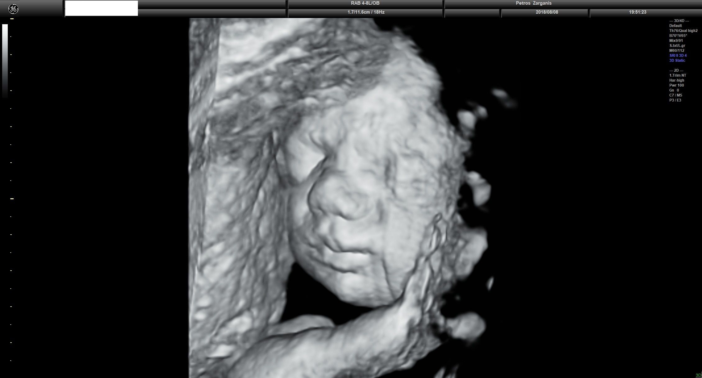 Εμβρυο 27+4 εβδομάδων Τρισδιάστατη Υπερηχογραφία 1