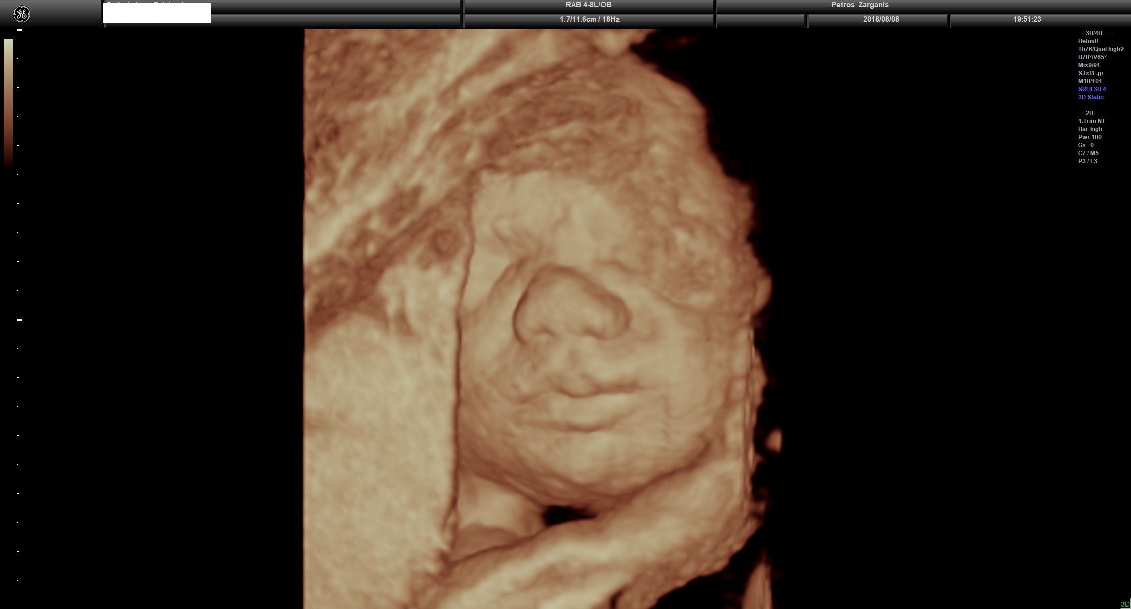 Εμβρυο 27+4 εβδομάδων Τρισδιάστατη Υπερηχογραφία 2