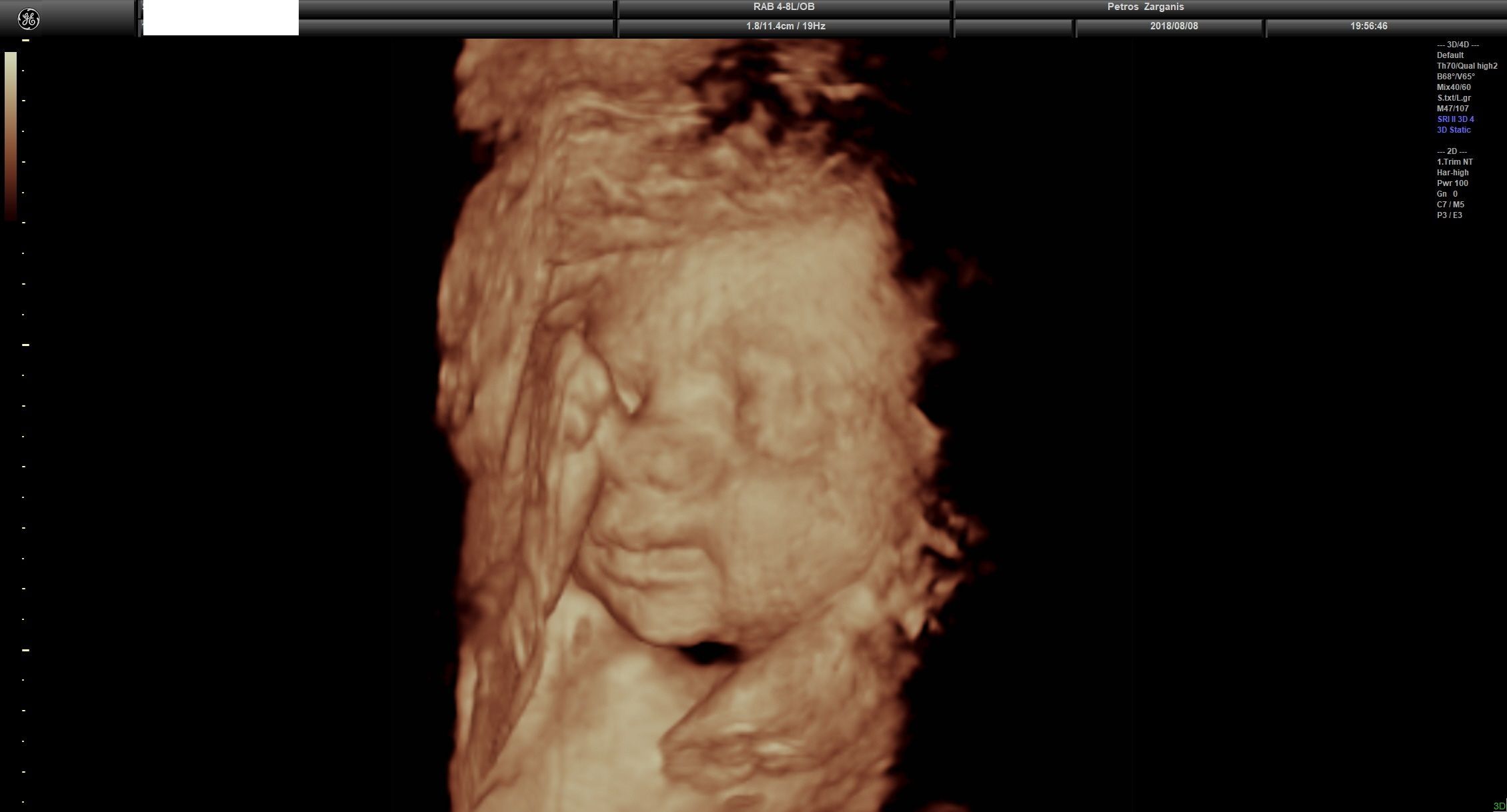 Εμβρυο 27+4 εβδομάδων Τρισδιάστατη Υπερηχογραφία 4