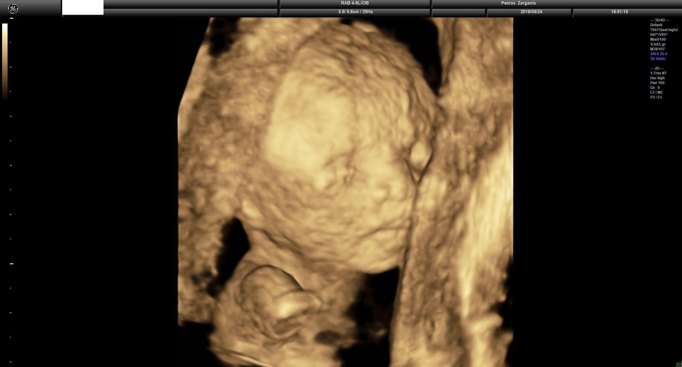 Εμβρυο 16+3  εβδομάδων Τρισδιάστατη Υπερηχογραφία
