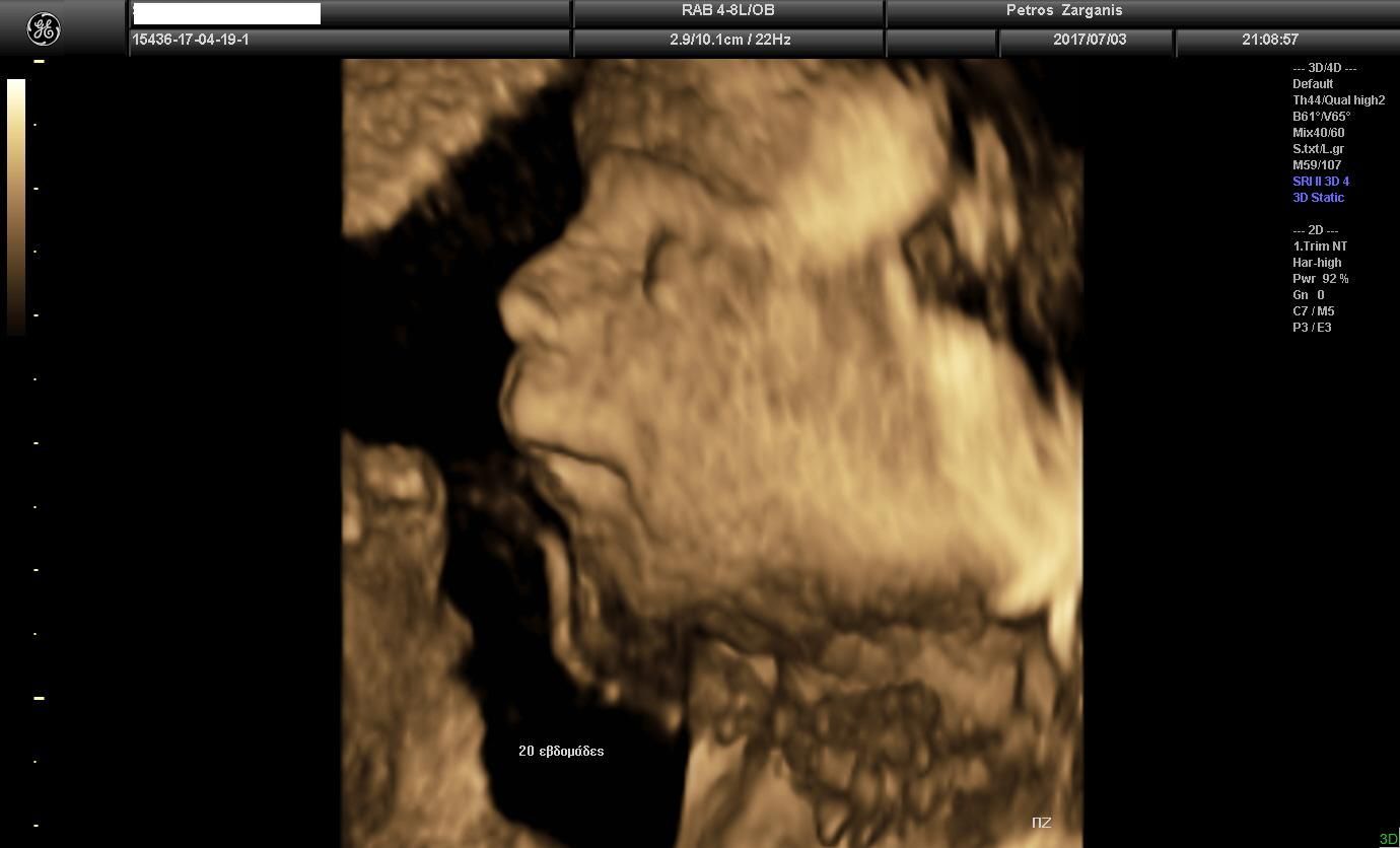Πρόσωπο Εμβρύου Στις 20 εβδομάδες