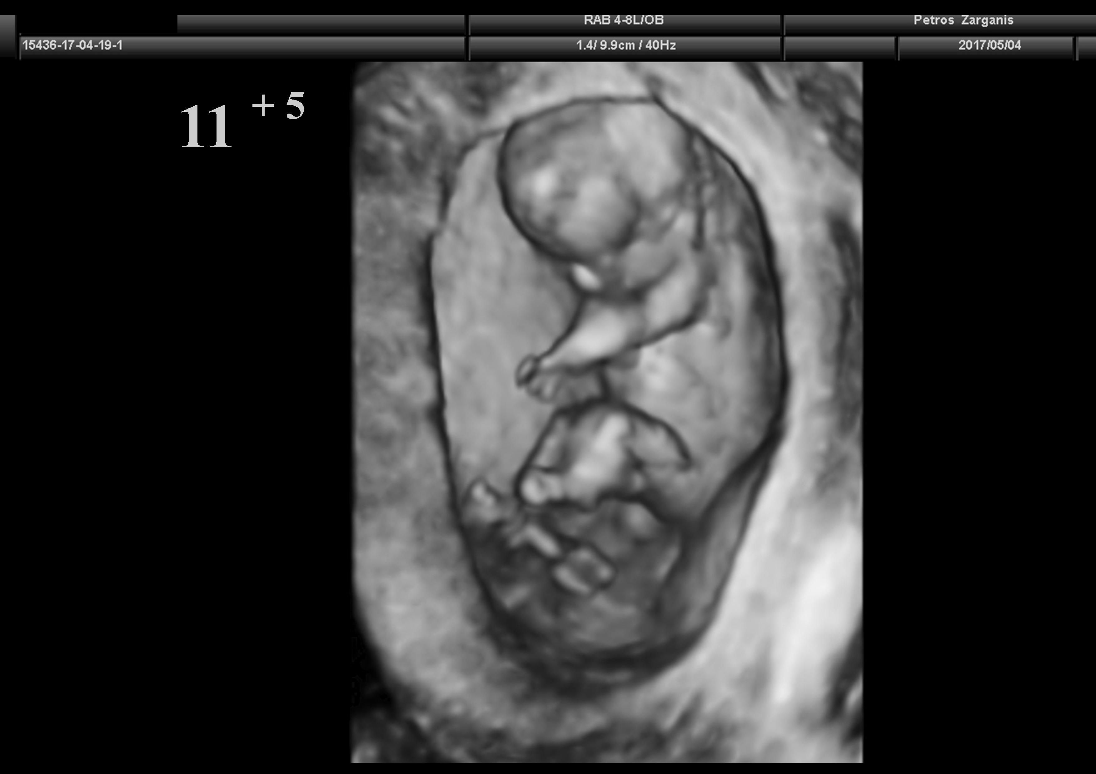 Tρισδιάστατη Προγεννητική Υπερηχογραφια 3D : Εμβρυο 11 Εβδομάδων .