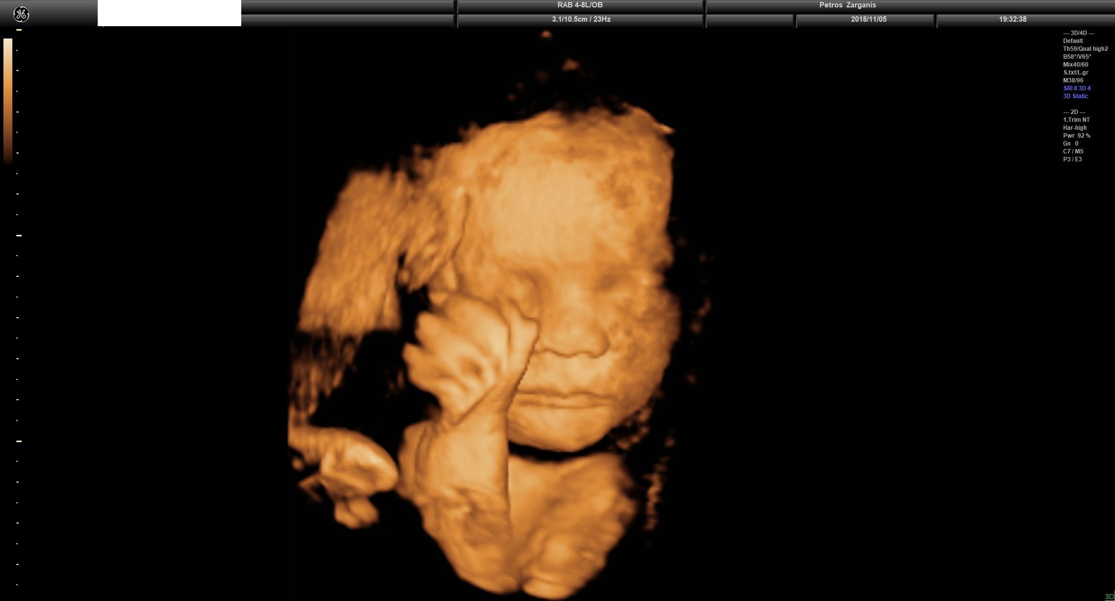Εμβρυο 31 Εβδομάδων και 3 ημερών Προγεννητική Υπερηχογραφία 3D 1