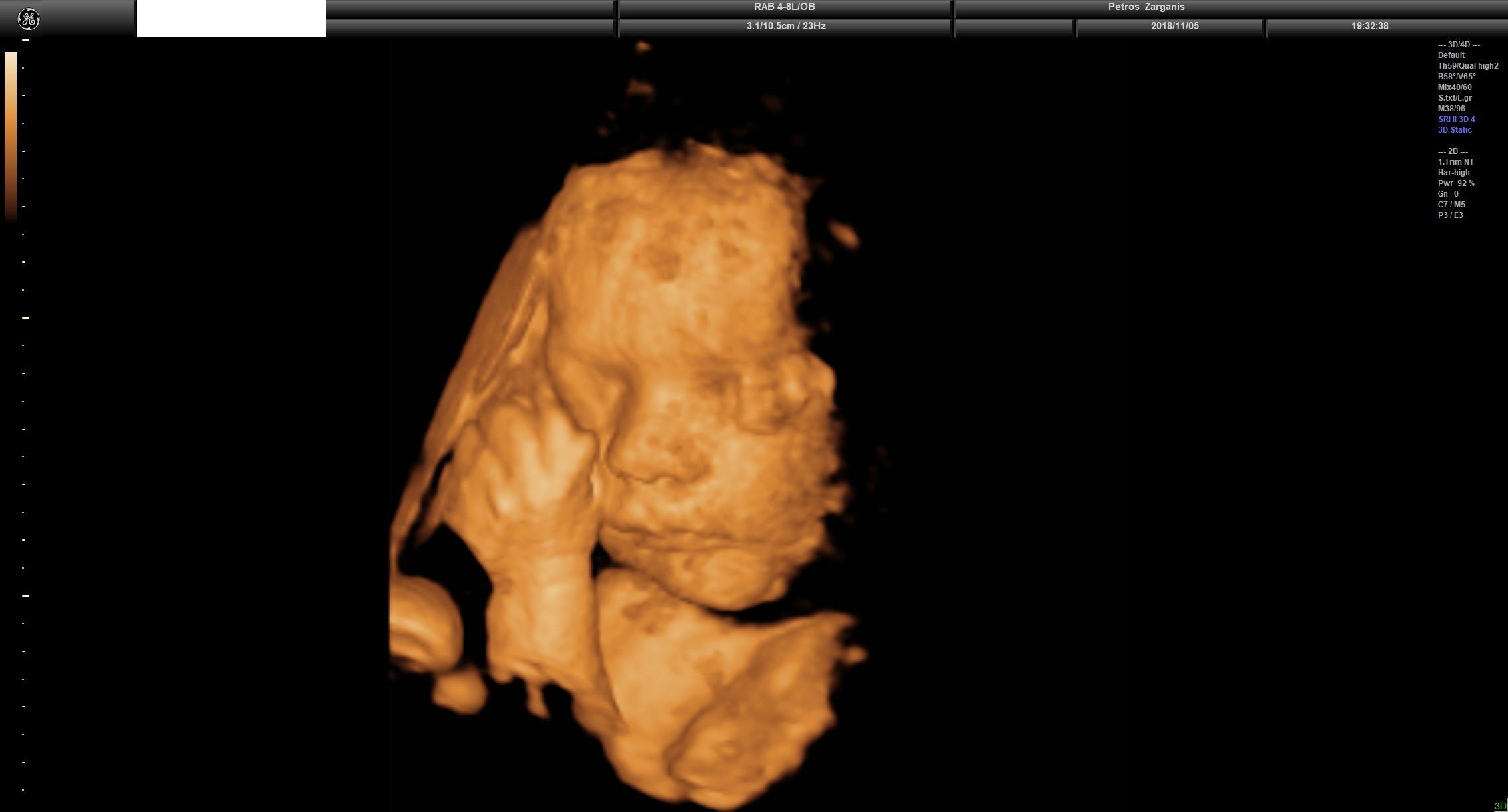Εμβρυο 31 Εβδομάδων και 3 ημερών Προγεννητική Υπερηχογραφία 3D 2