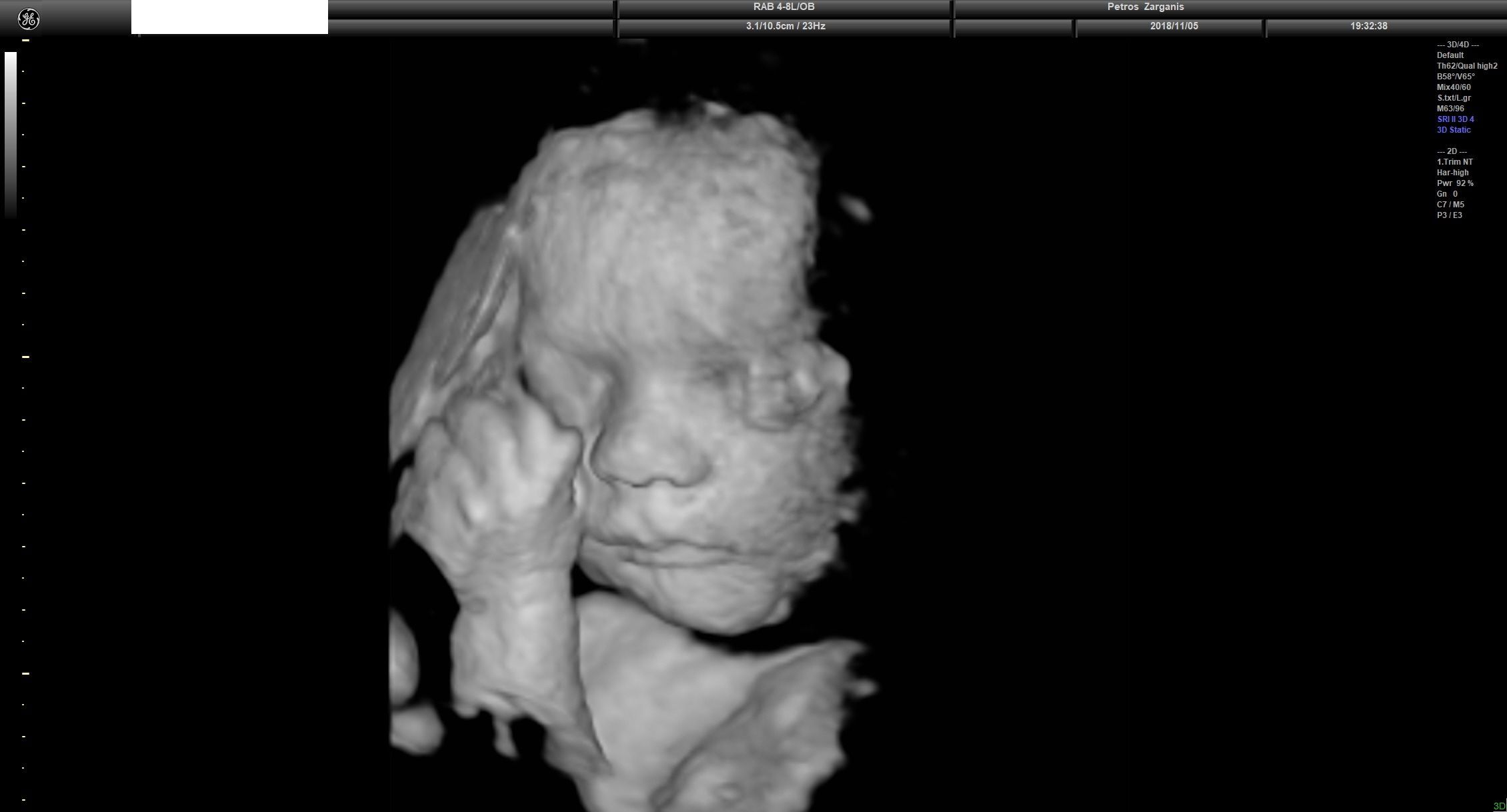 Εμβρυο 31 Εβδομάδων και 3 ημερών Προγεννητική Υπερηχογραφία 3D 4