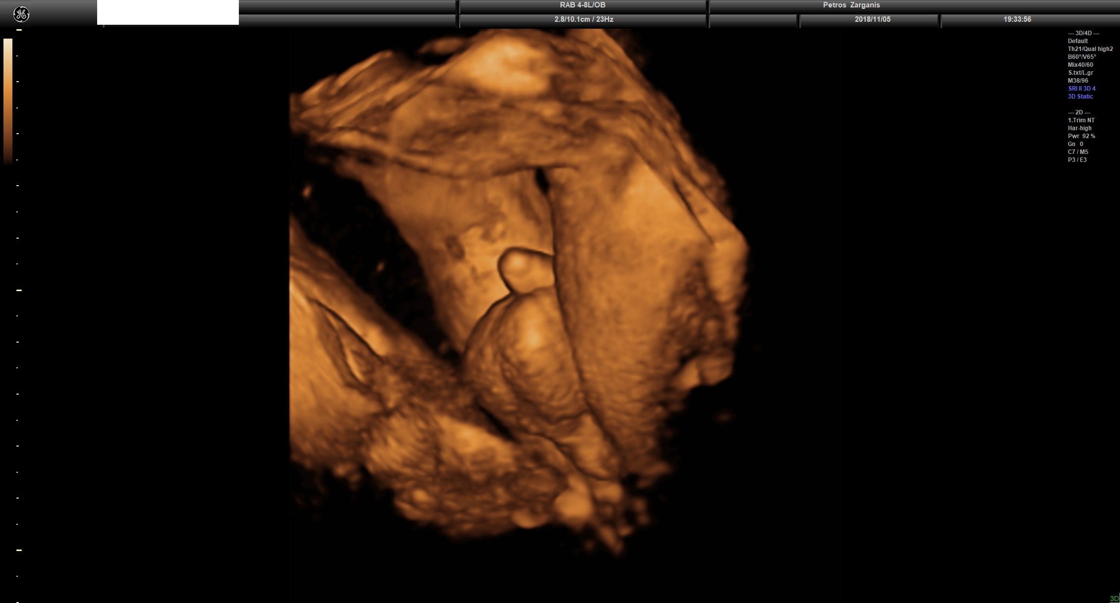 Εμβρυο 31 Εβδομάδων και 3 ημερών Όσχεο Όρχεις Και Πέος Γεννητικά Όργανα Άρρενος Προγεννητική Υπερηχογραφία 3D 1