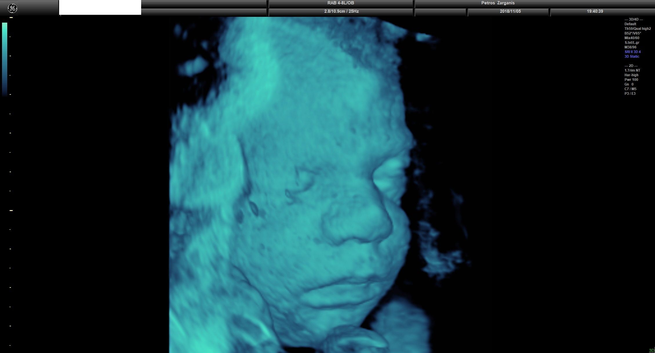 Εμβρυο 31 Εβδομάδων και 3 ημερών Τρισδιάστατη Προγεννητική Υπερηχογραφία 6