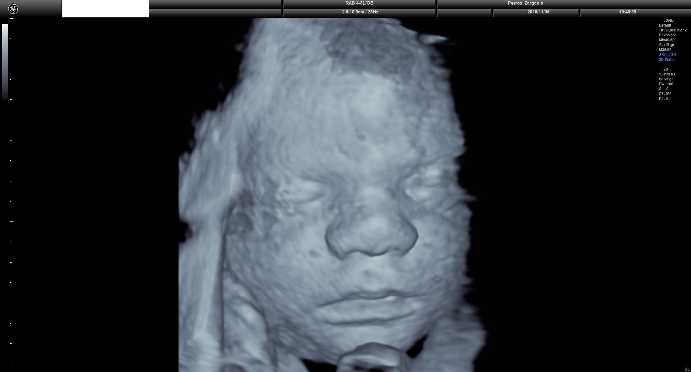 Εμβρυο 31 Εβδομάδων και 3 ημερών Τρισδιάστατη Προγεννητική Υπερηχογραφία 7