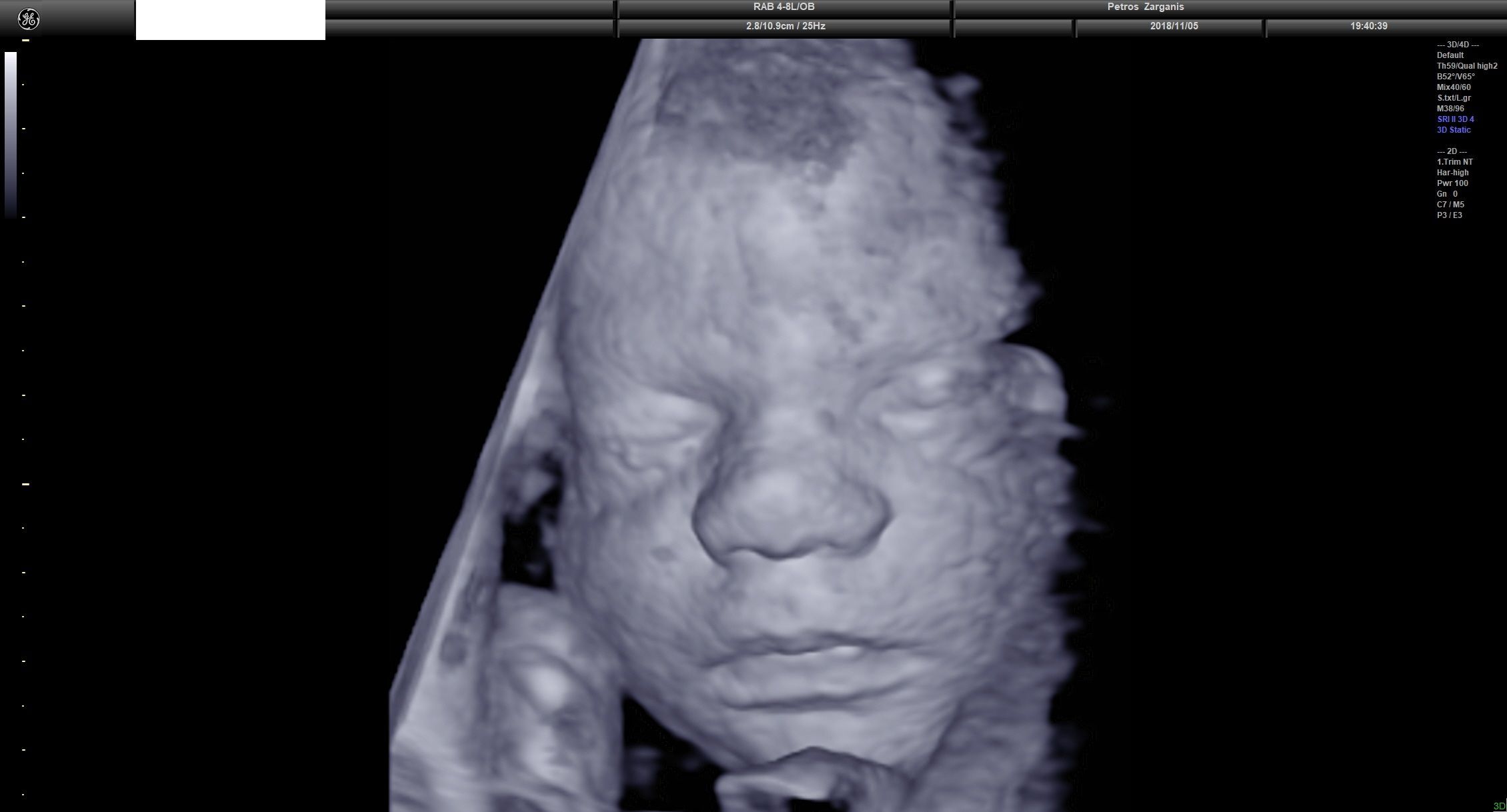 Εγκυμοσύνη 31 Εβδομάδων και 3 ημερών Τρισδιάστατη Προγεννητική Υπερηχογραφία ΠΖαργάνης 8
