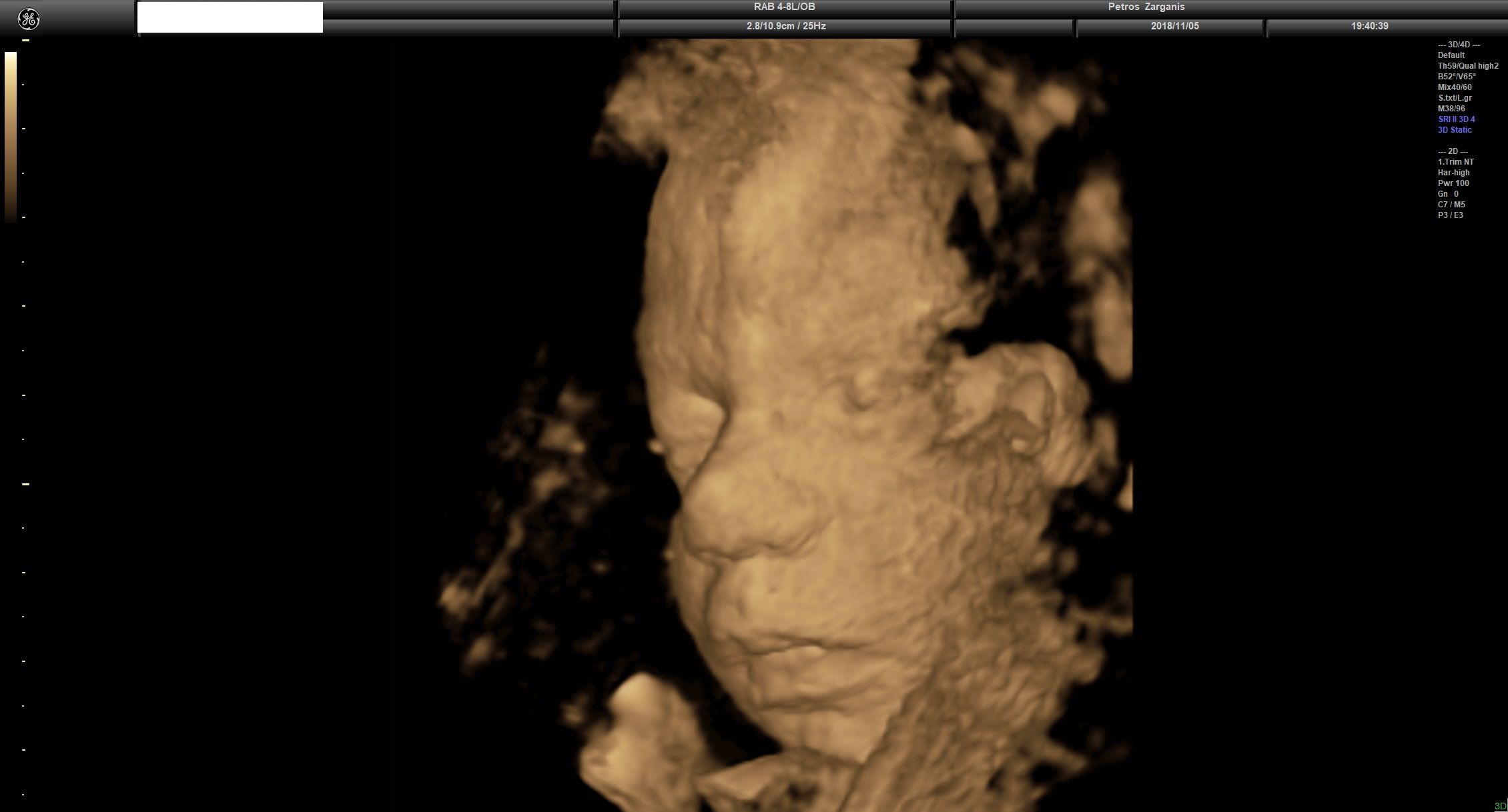 Εγκυμοσύνη 31 Εβδομάδων και 3 ημερών Τρισδιάστατη Προγεννητική Υπερηχογραφία ΠΖαργάνης 10