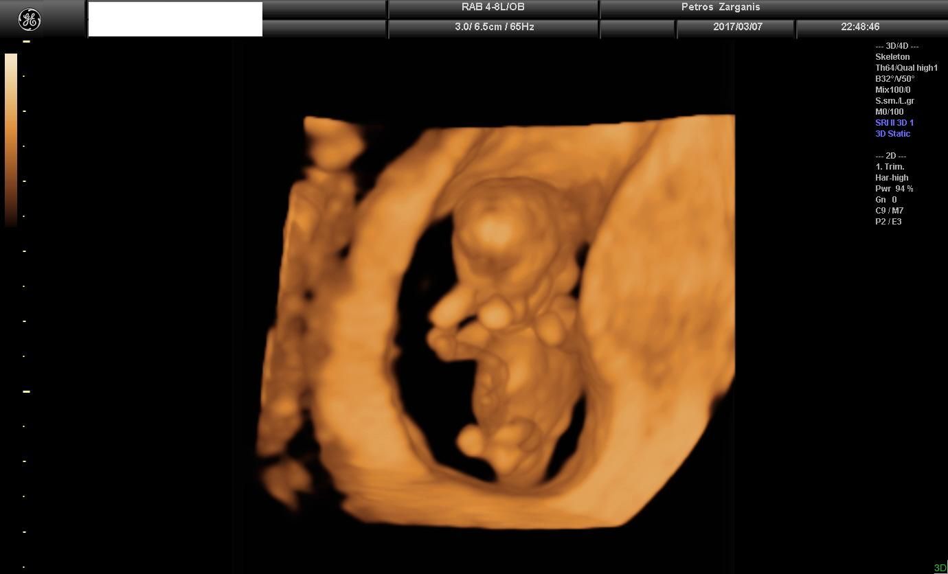 Tρισδιάστατη Προγεννητική Υπερηχογραφια 3D : Εμβρυο 11 Εβδομάδων .