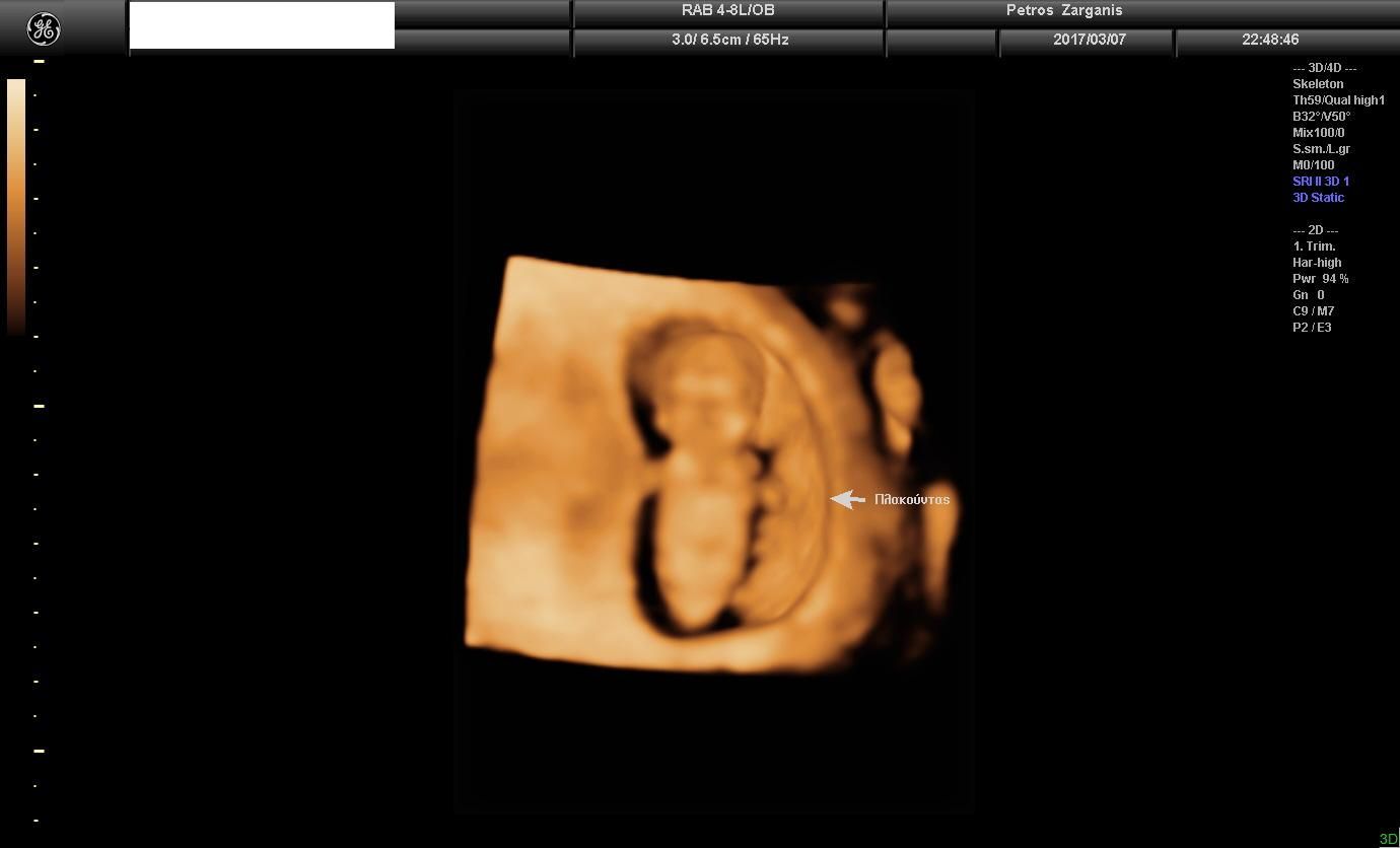 Πλακουντας - Έμβρυο Συγκριτικα μεγέθη στις 11 εβδομάδες