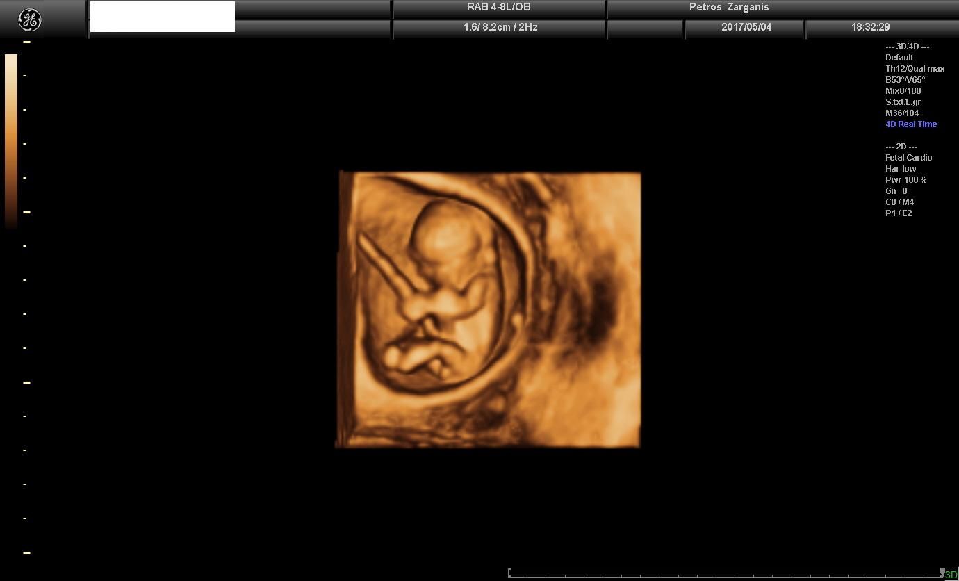Εμβρυο 10+4 εβδομάδων τρισδιάστατη υπερηχογραφία
