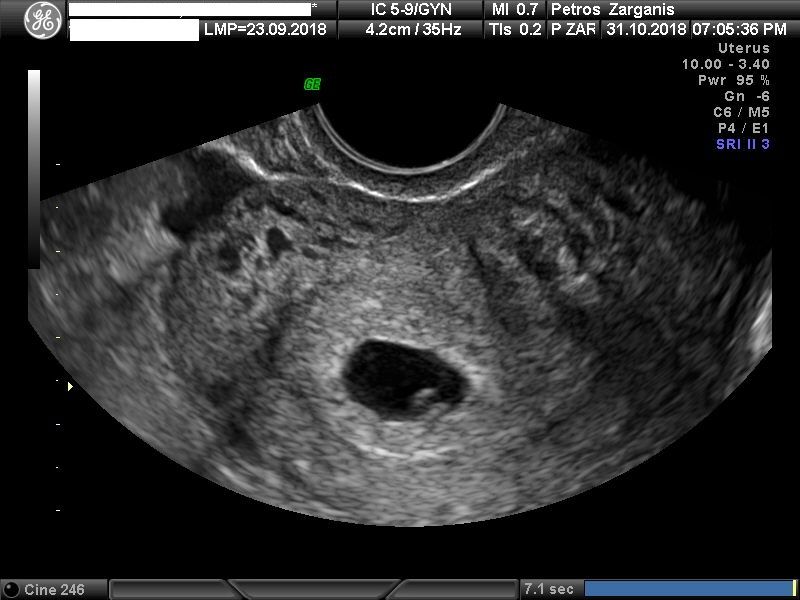 Έμβρυο 5εβδ 3ημ με δύο ενδοτοιχωματικά ινομυώματα στα αριστερά και δεξιά