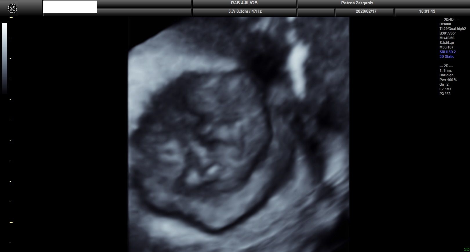 Εμβρυο 10+2 εβδομάδων τρισδιάστατη υπερηχογραφία