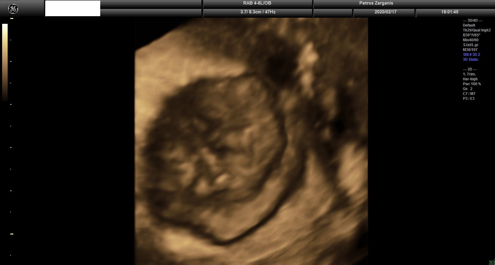 Εμβρυο 10+2 εβδομάδων τρισδιάστατη υπερηχογραφία
