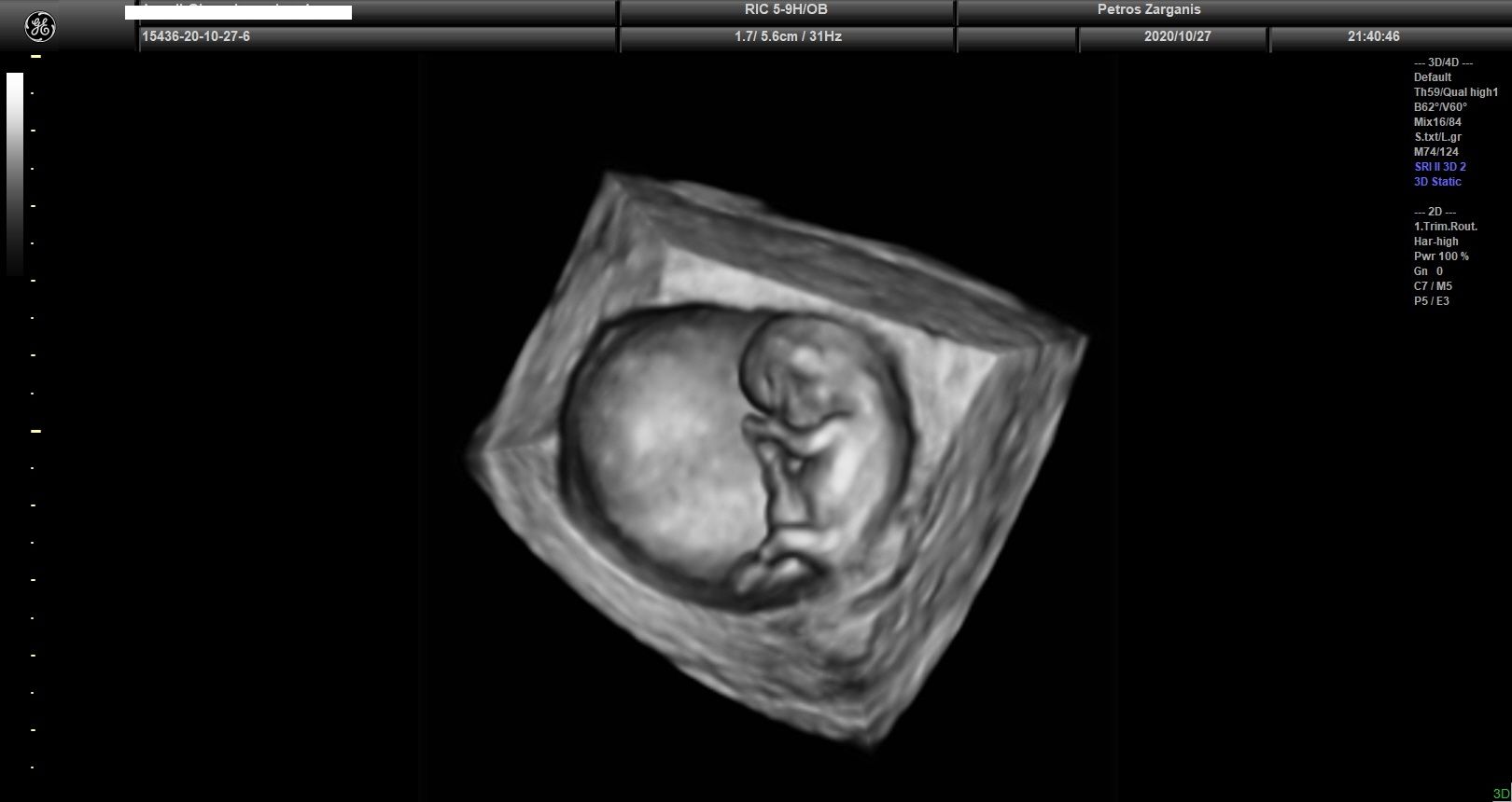 Εμβρυο 10+2 εβδομάδων τρισδιάστατη υπερηχογραφία[1]