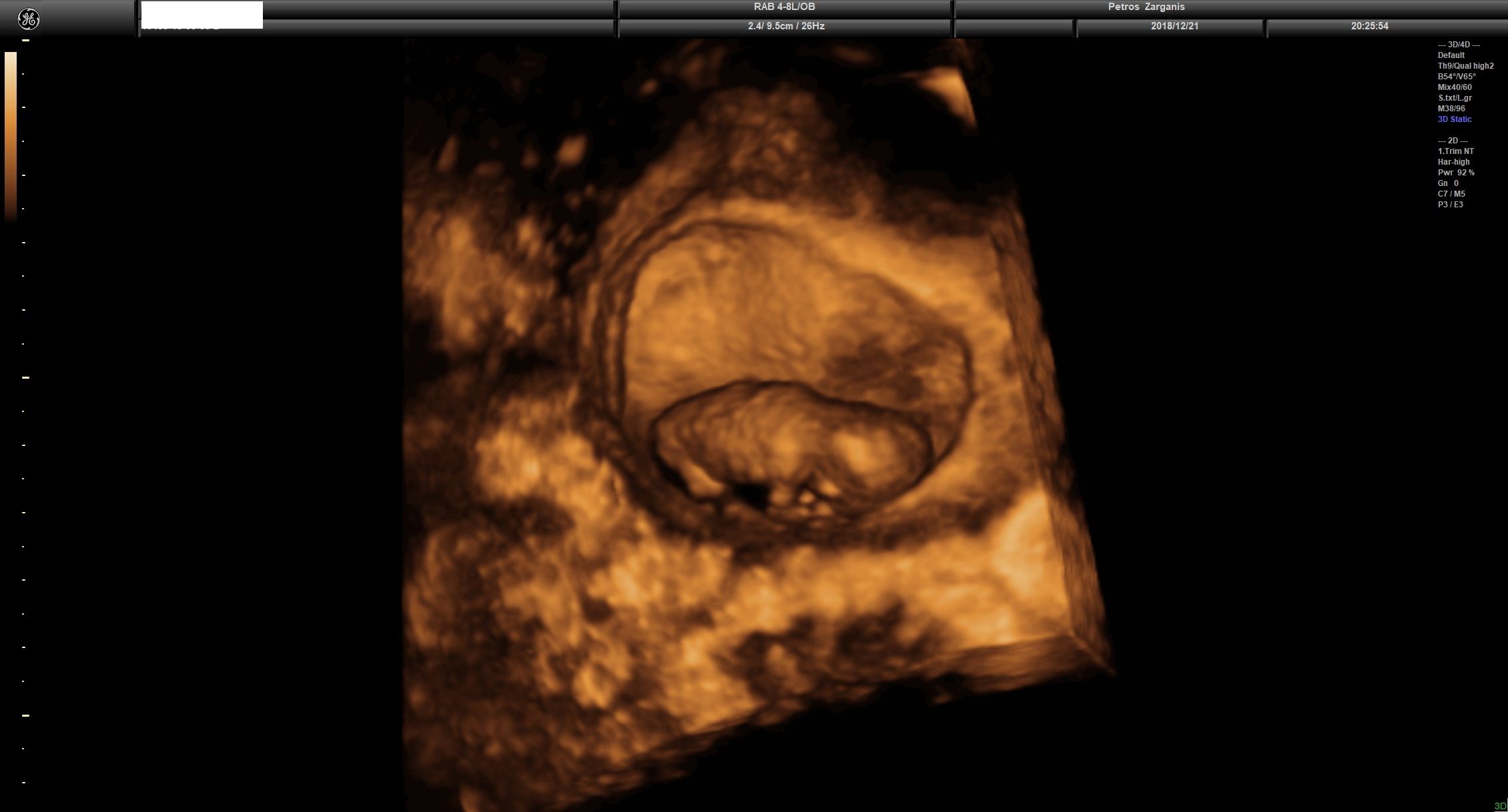 Εμβρυο 10+4 εβδομάδων τρισδιάστατη υπερηχογραφία[1]