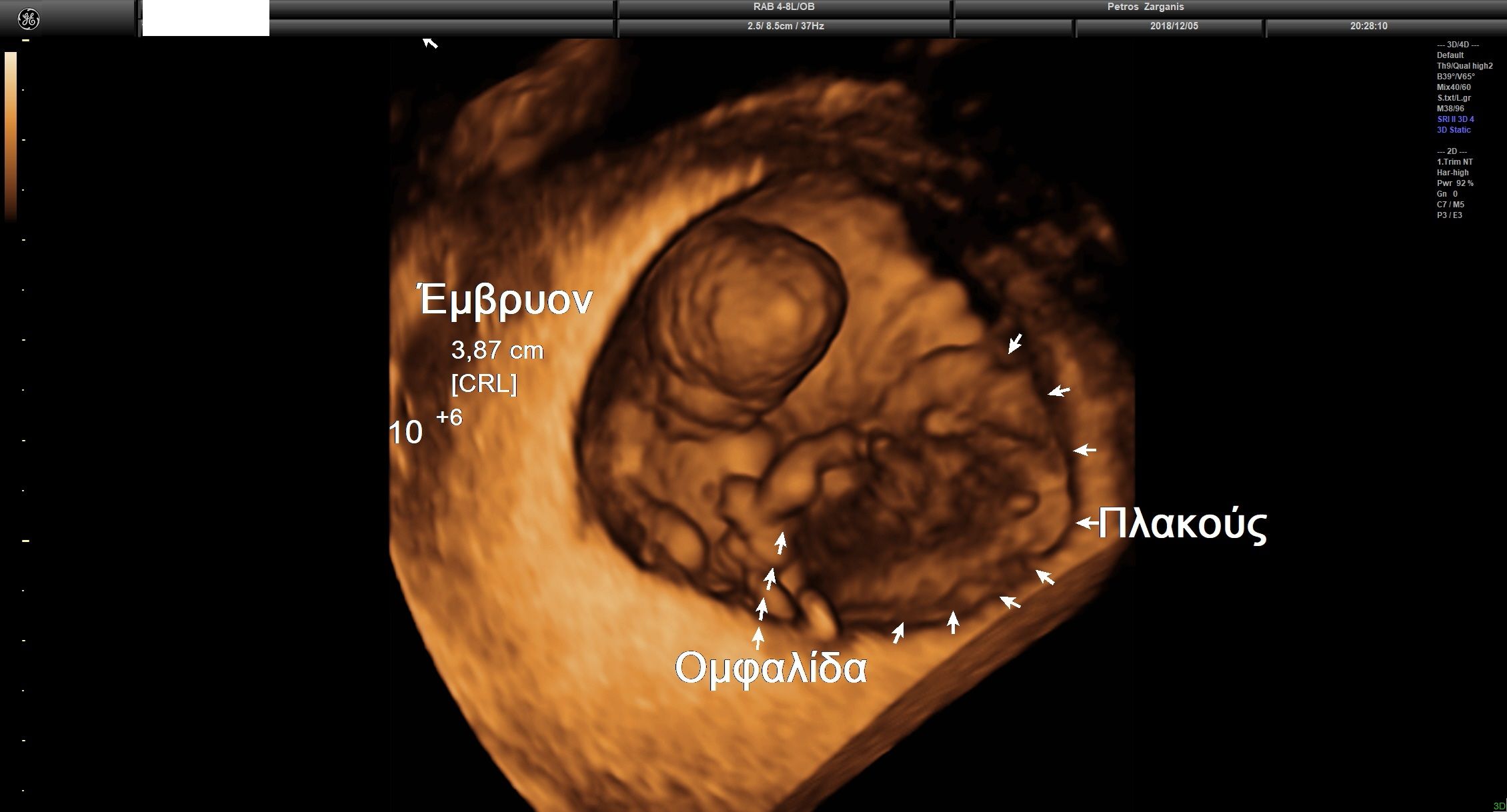Εμβρυο 10+3 εβδομάδων τρισδιάστατη υπερηχογραφία[1]