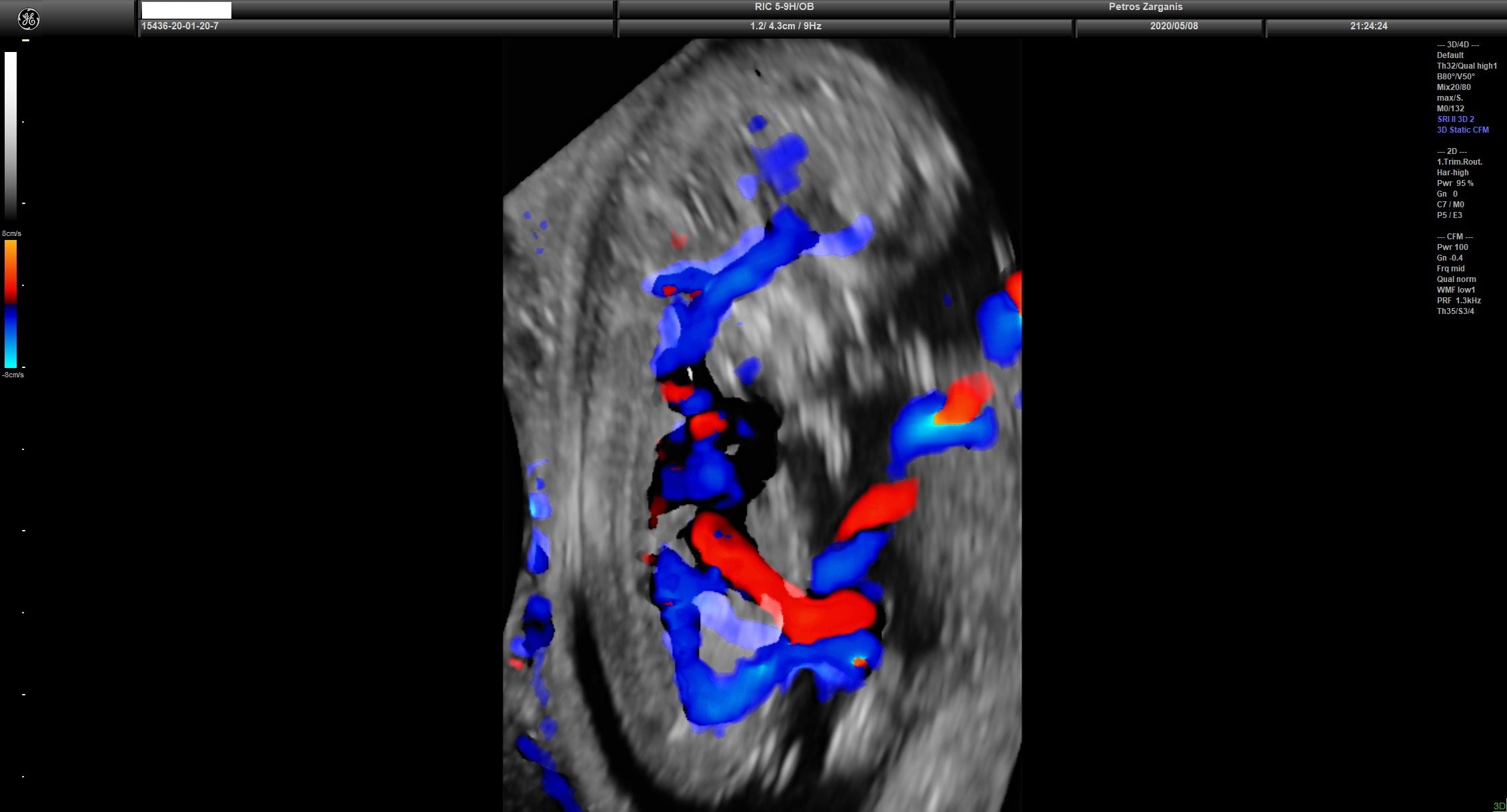Εμβρυϊκή Κυκλοφορία Στις 11 εβδ +1 ημ . Διακρίνεται ο διαχωρισμός του ομφαλίου λώρου σε ομφαλική φλέβα και σε δύο  ομφαλικές αρτηρίες 