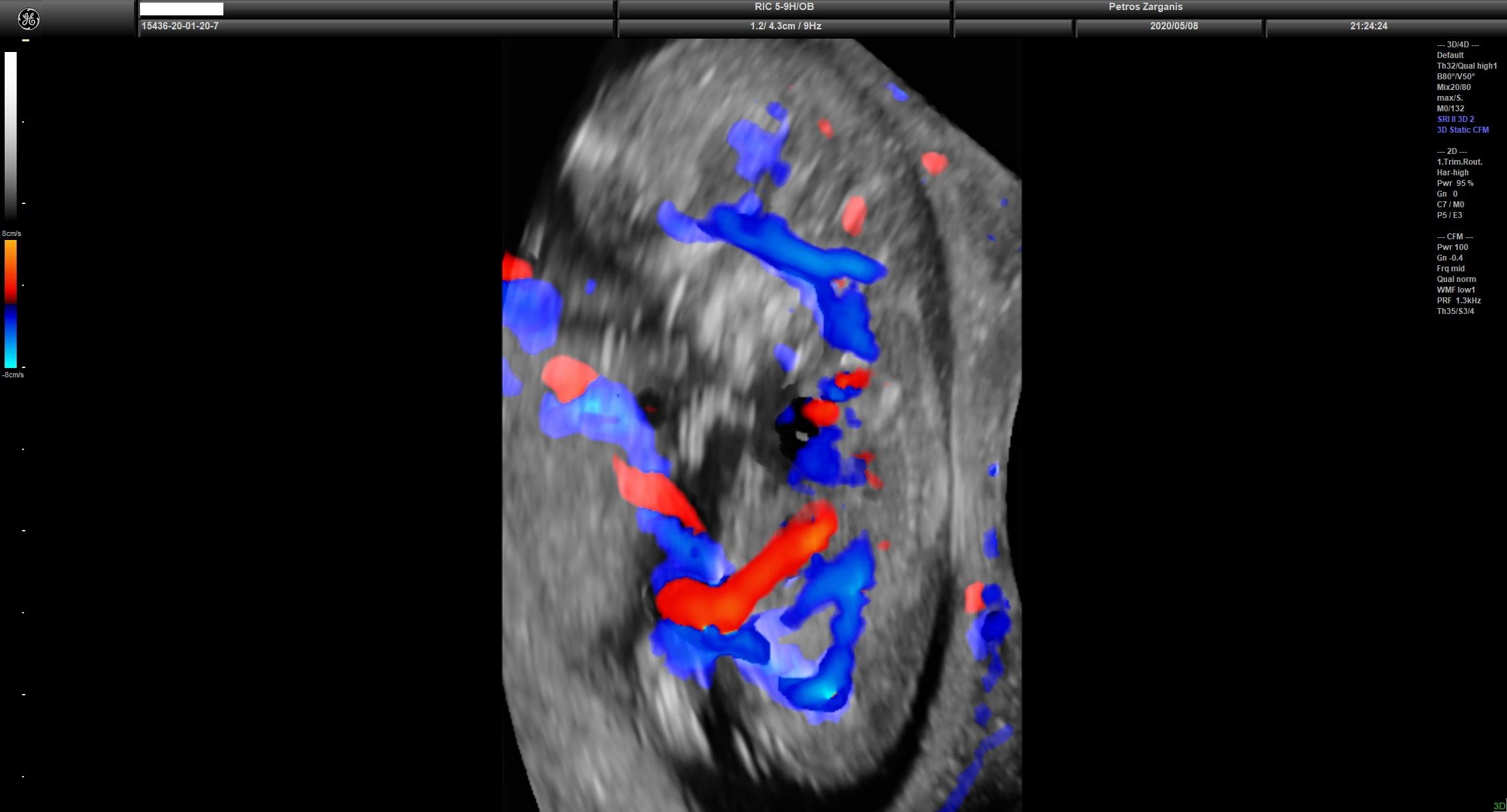 Εμβρυϊκή Κυκλοφορία Στις 11 εβδ +1 ημ . Διακρίνεται ο διαχωρισμός του ομφαλίου λώρου σε ομφαλική φλέβα και σε δύο  ομφαλικές αρτηρίες [2]