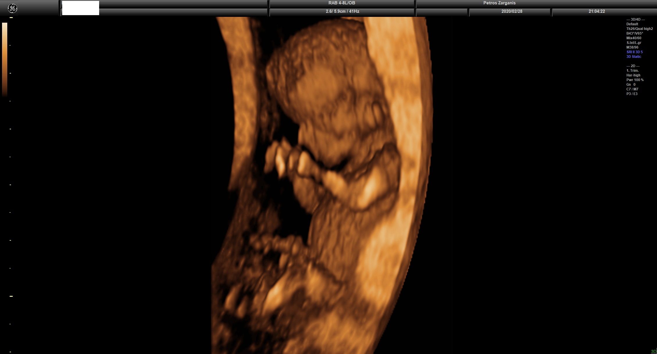 Εμβρυο 11 εβδομάδων +2 ημερών τρισδιάστατη απεικόνιση , σε εγκυμοσύνη με κολπική αιμόρροια και ευχάριστη εξέλιξη [1]