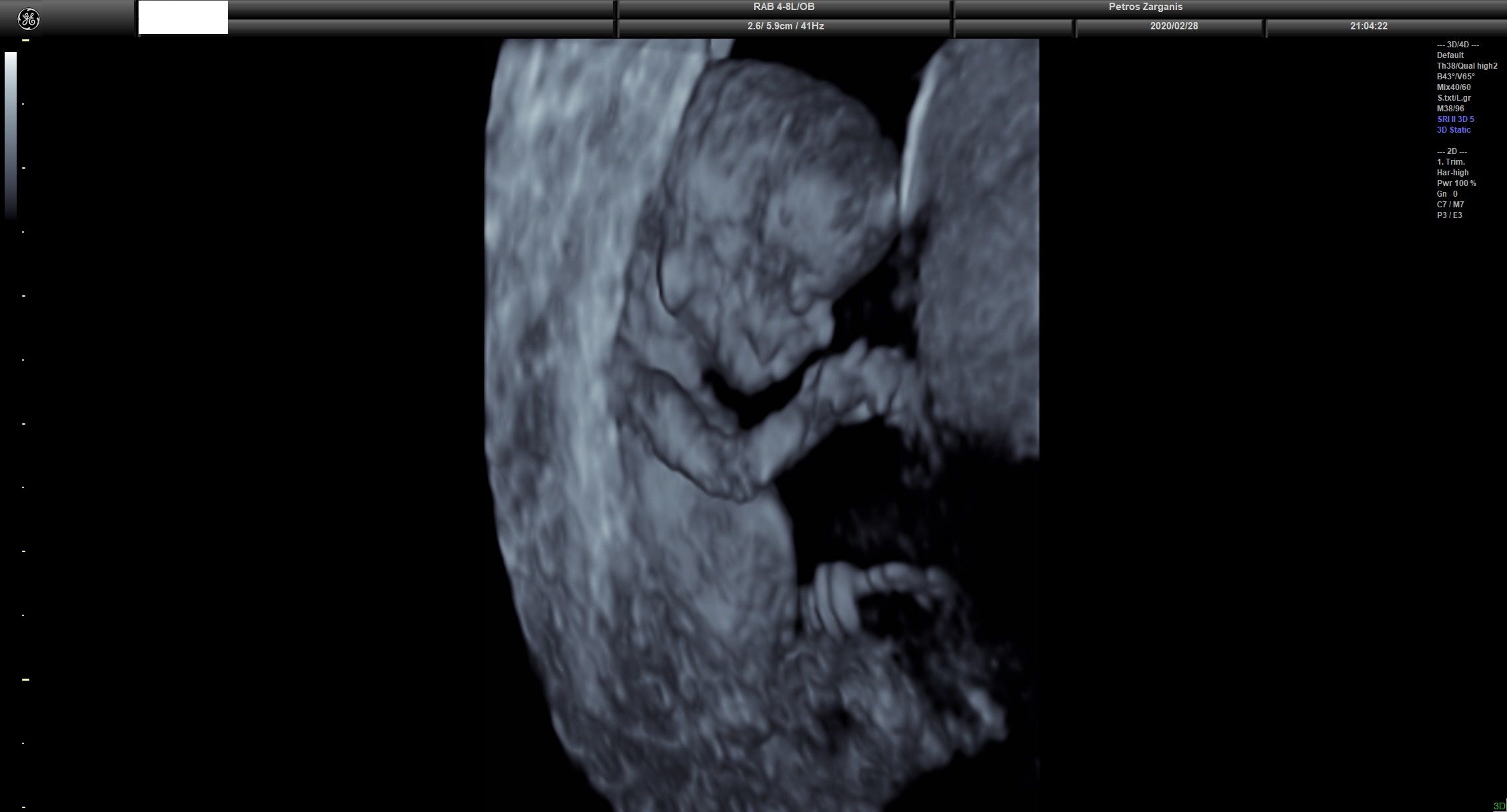 Εμβρυο 11 εβδομάδων +2 ημερών τρισδιάστατη απεικόνιση , σε εγκυμοσύνη με κολπική αιμόρροια και ευχάριστη εξέλιξη [2]