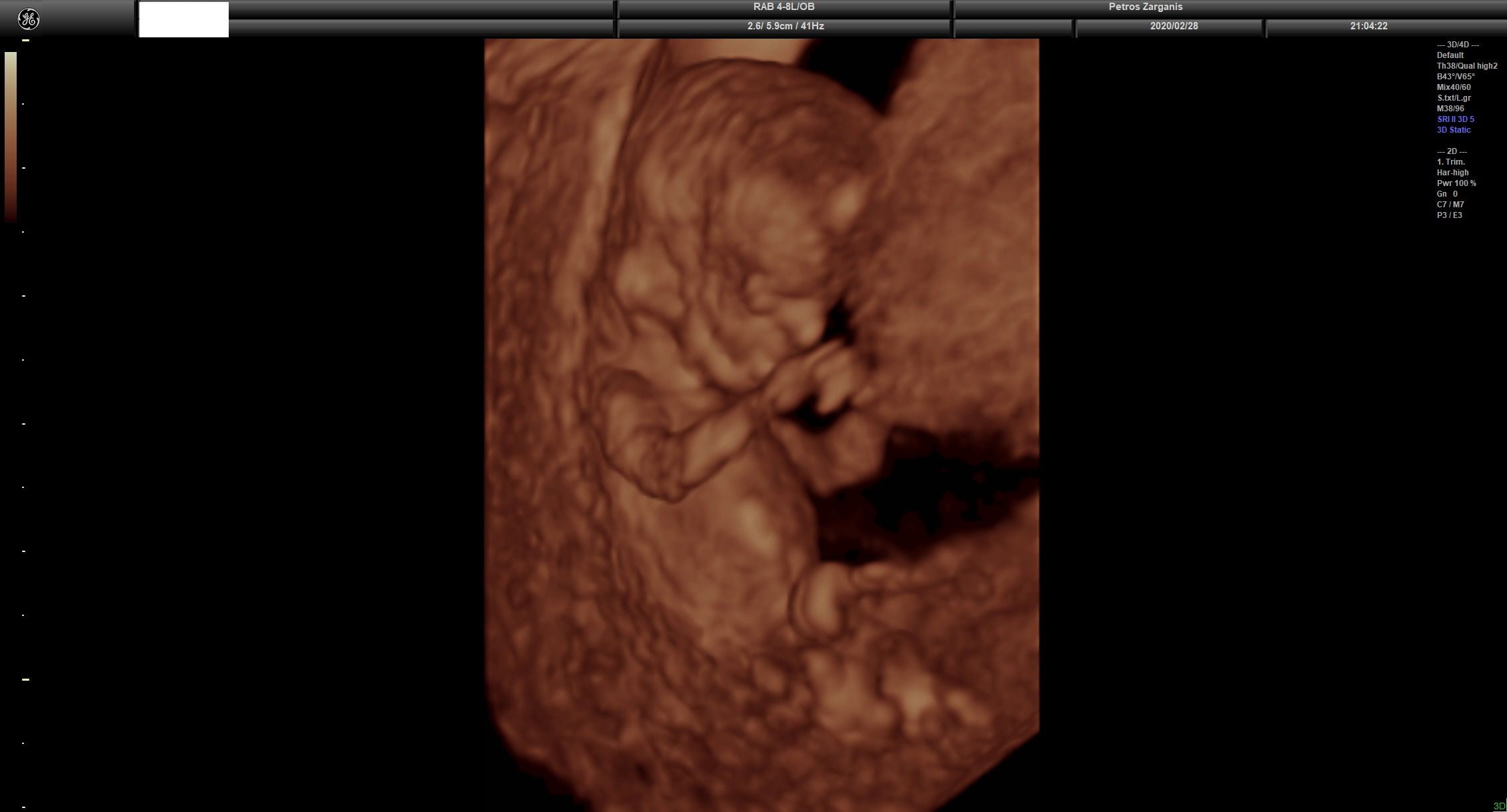 Εμβρυο 11 εβδομάδων +2 ημερών τρισδιάστατη απεικόνιση , σε εγκυμοσύνη με κολπική αιμόρροια και ευχάριστη εξέλιξη [3]