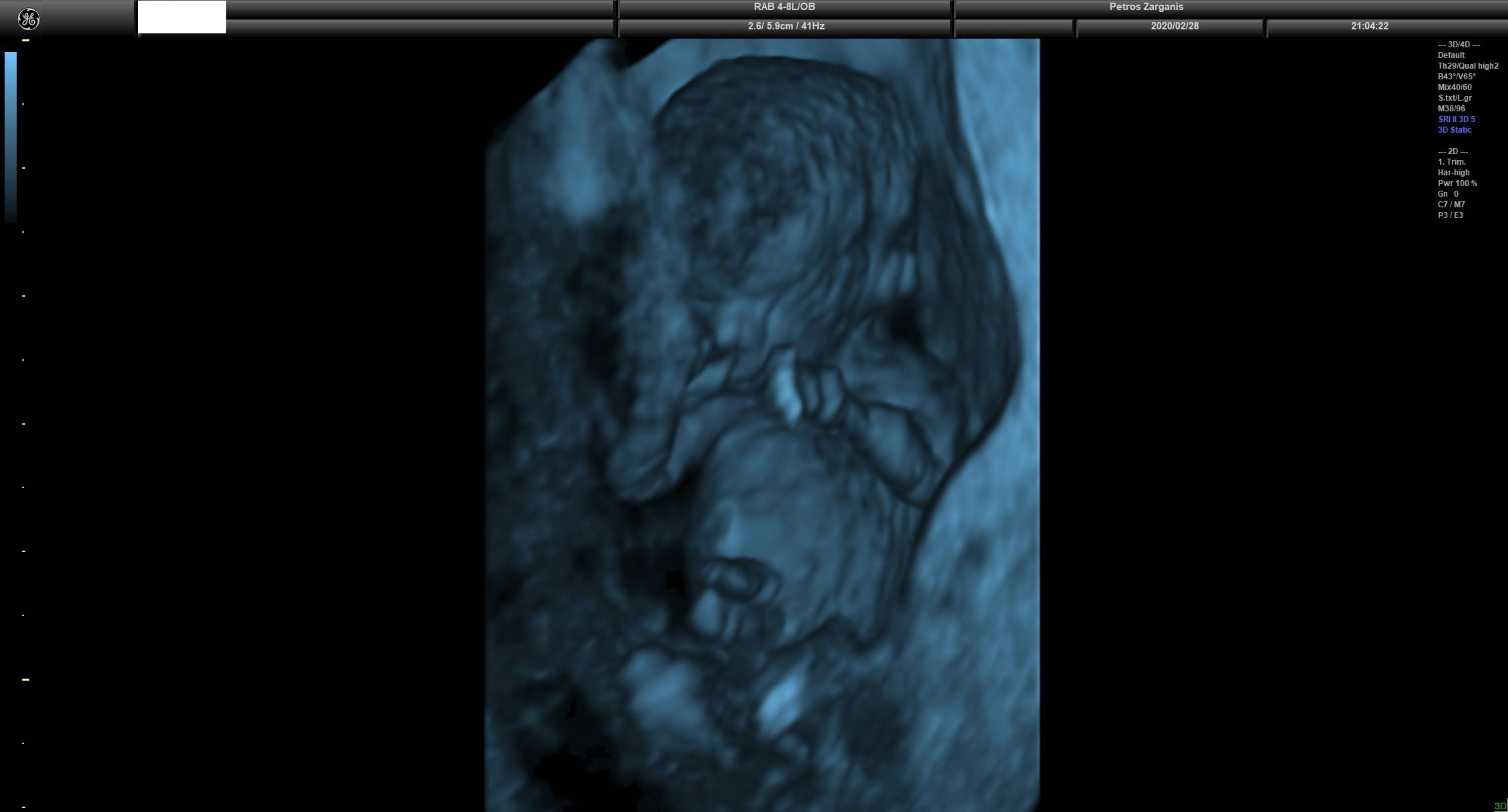 Εμβρυο 11 εβδομάδων +2 ημερών τρισδιάστατη απεικόνιση , σε εγκυμοσύνη με κολπική αιμόρροια και ευχάριστη εξέλιξη [4]