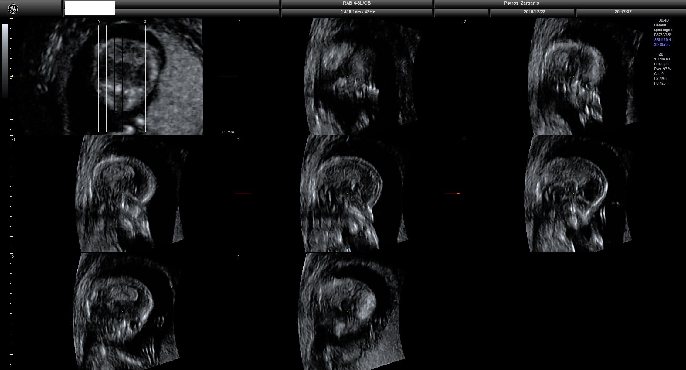 Εμβρυο 13 εβδομάδων +4 ημερών, Πολλαπλές Τομές Εγκεφάλου [5]