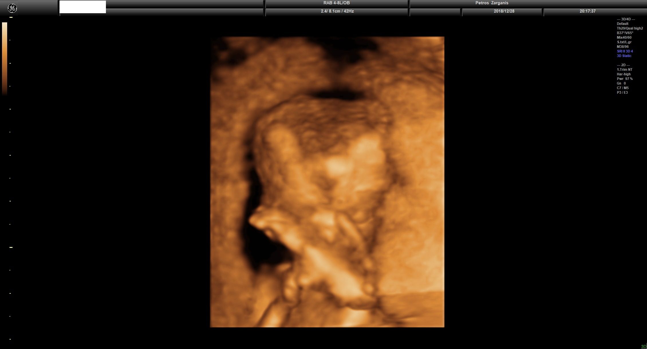 Εμβρυο 13 εβδομάδων +4 ημερών, 8,3 εκατοστά , Σκελετός Προσώπου Και Κρανίου [1]