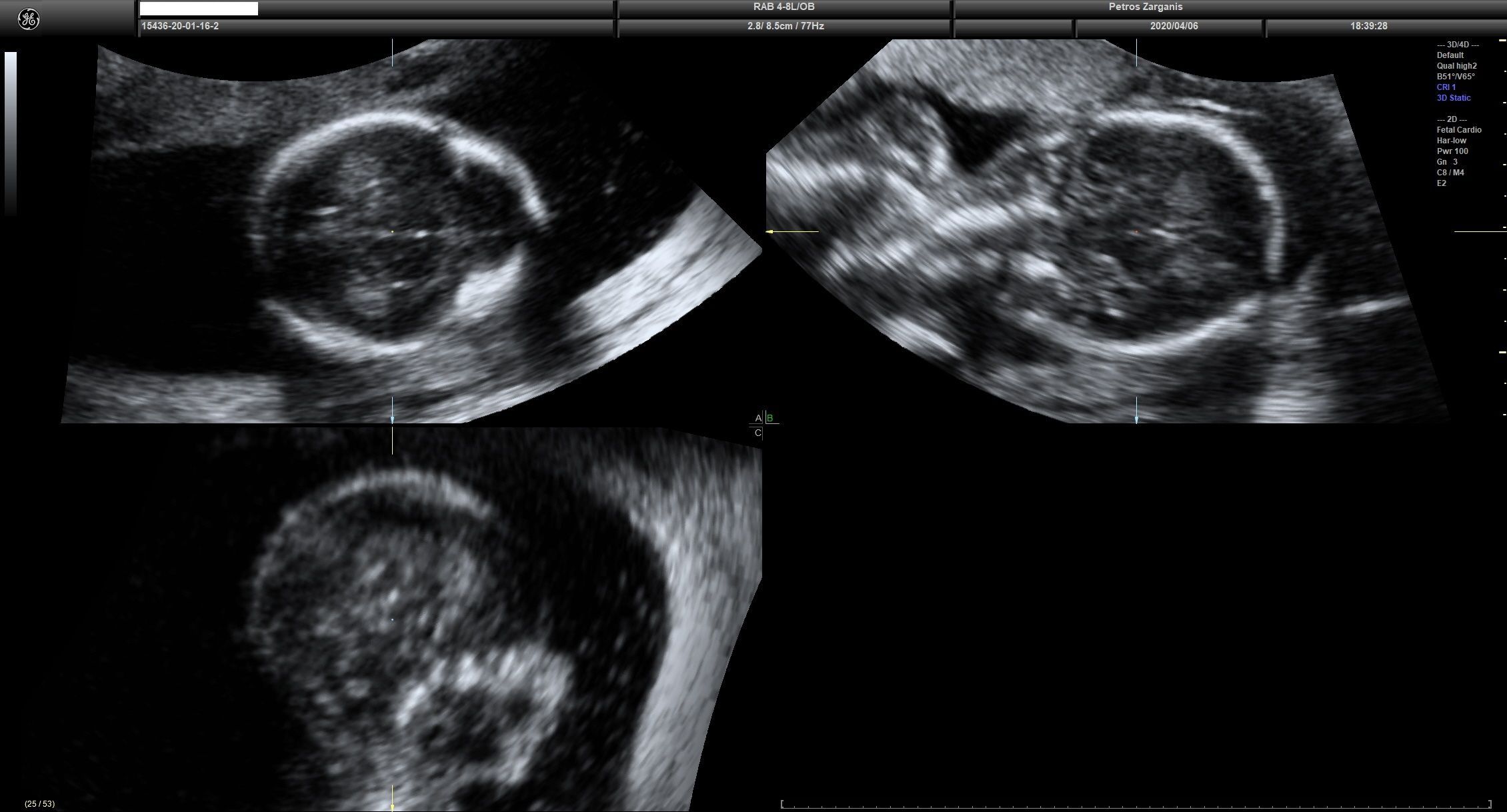 Εμβρυο 17 εβδομάδων +7 ημερών, Πολλαπλές Τομές Εγκεφάλου [1]