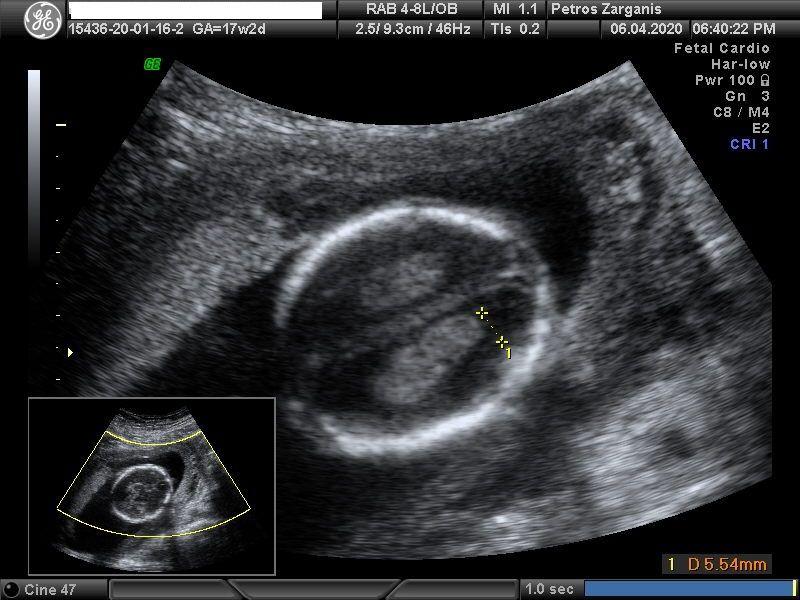 Εμβρυο 17 εβδομάδων +2 ημερών, Πολλαπλές Τομές Εγκεφάλου [1]