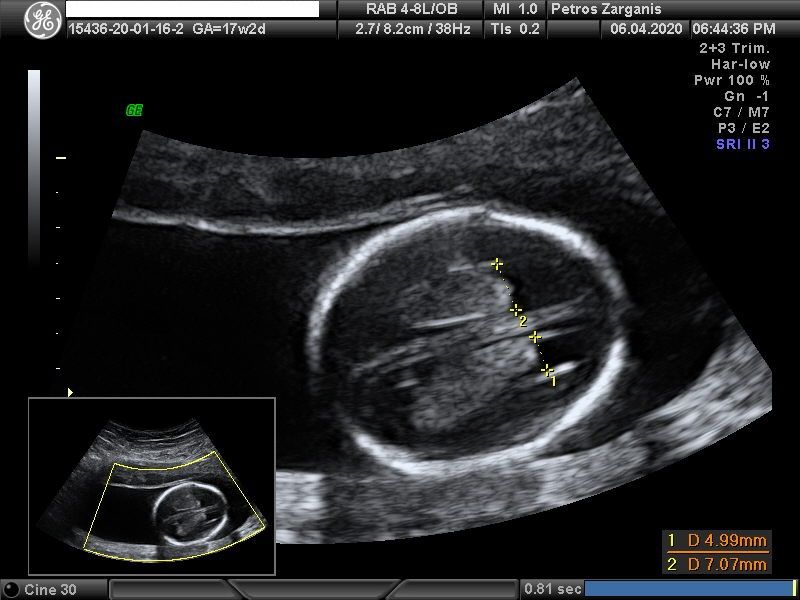 Εμβρυο 17 εβδομάδων +2 ημερών, Πολλαπλές Τομές Εγκεφάλου [1]