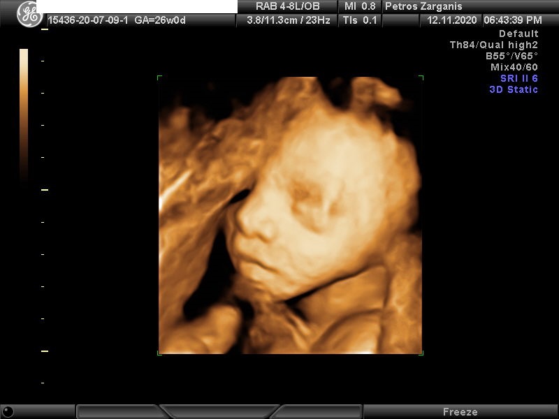 Εμβρυο 26 εβδομάδων[5] Τρισδιάστατη Υπερηχογραφία