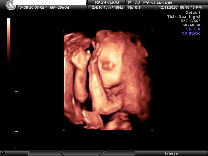 Εμβρυο 26 εβδομάδων[5] Τρισδιάστατη Υπερηχογραφία