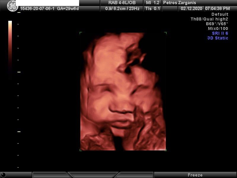 Εμβρυο 29 Εβδομάδων[5] Τρισδιάστατη Υπερηχογραφία