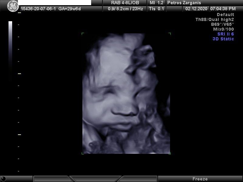 Εμβρυο 29 Εβδομάδων[5] Τρισδιάστατη Υπερηχογραφία