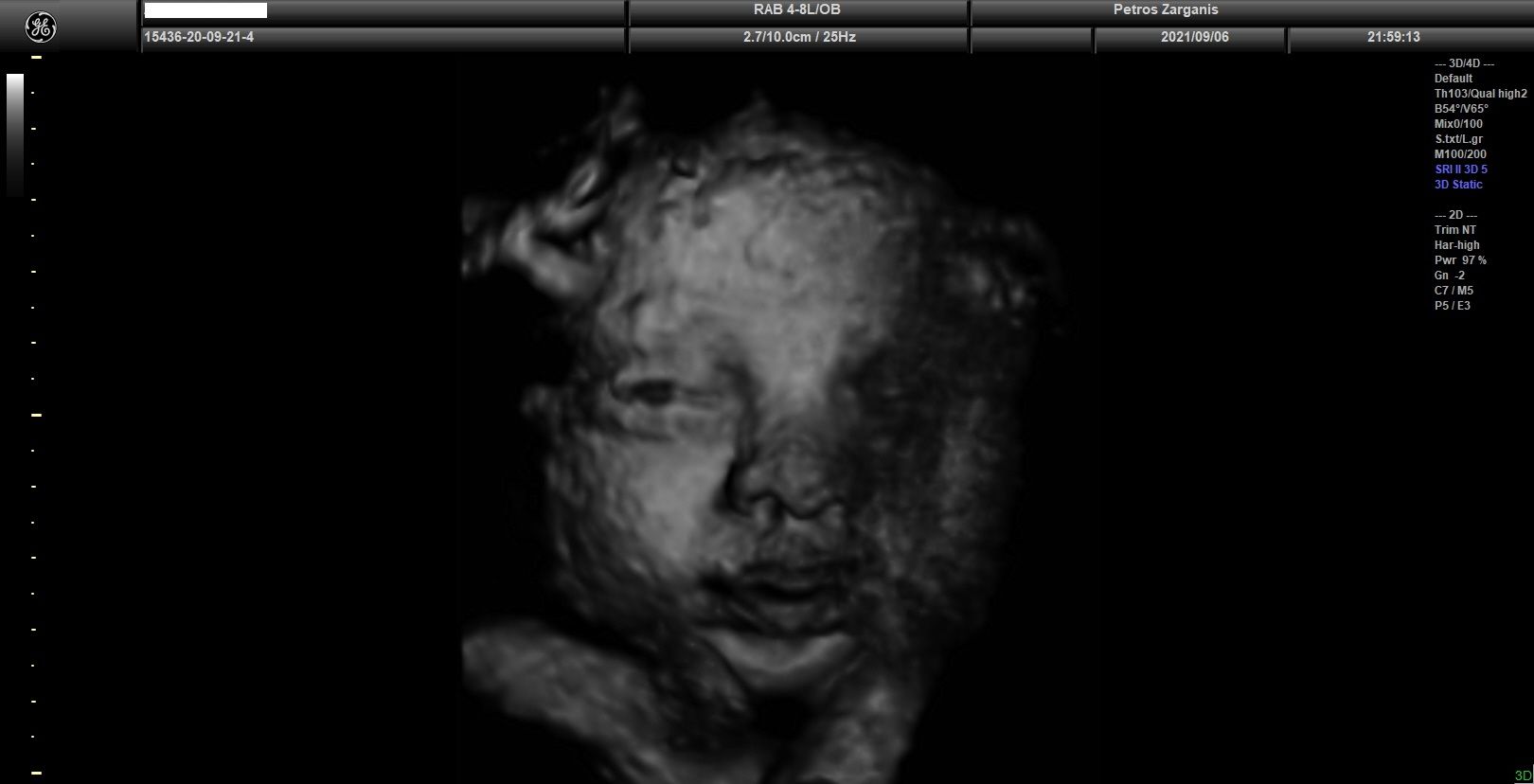 Εμβρυο 33 εβδομάδων + 4  ημερών με ανοικτά τα μάτια (το ένα φαίνεται μόνον) [1]