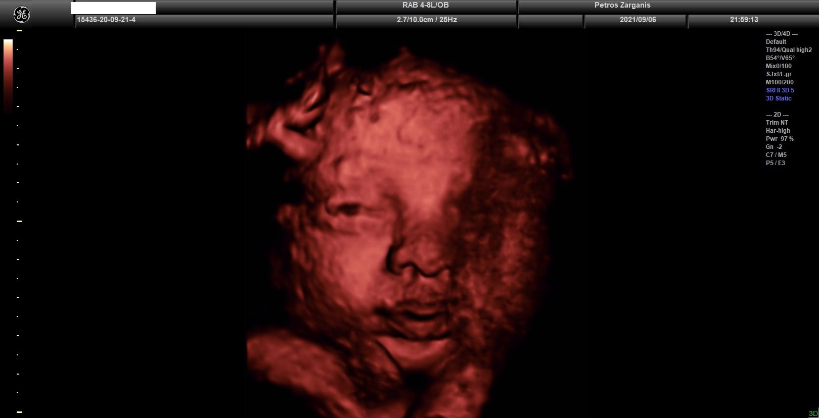 Εμβρυο 33 εβδομάδων + 4  ημερών με ανοικτά τα μάτια (το ένα φαίνεται μόνον) [2]