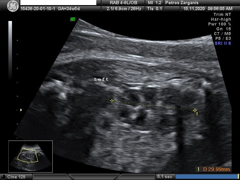 Φυσιολογικός νεφρός Εμβρύου 34 εβδομάδων +5 ημερών [4]